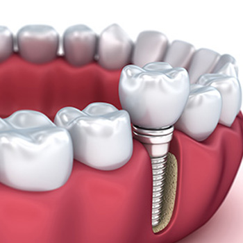 Dental Implants