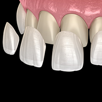 Dental Veneers