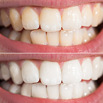 Teeth Whitening