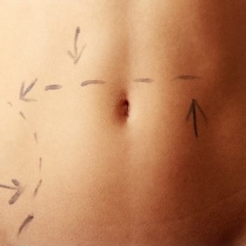 Tummy Tuck